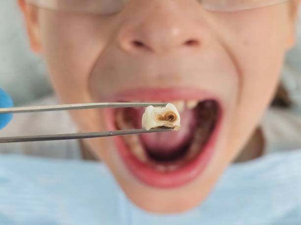 Best Emergency Wisdom Teeth Removal in East Norwich, NY
